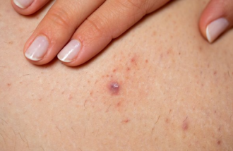 Ingrown Hair vs. Pimple: What’s the Difference?