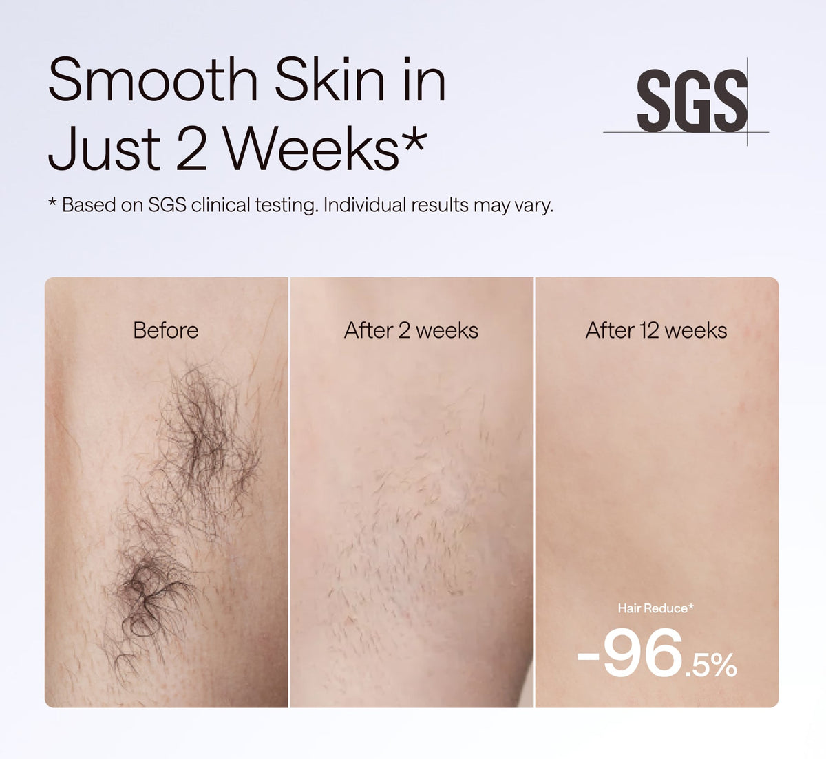 Ulike_Air_10_hair_reduction_in_Just_2_Weeks